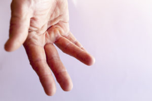 Dupuytren’s Disease